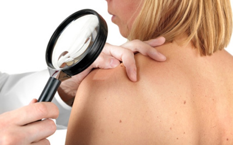 Melanoma, in arrivo un vaccino vegetale in grado di bloccarlo