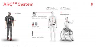 Onward Medical sperimenta con successo la tecnologia per far muovere le braccia a pazienti quadriplegici